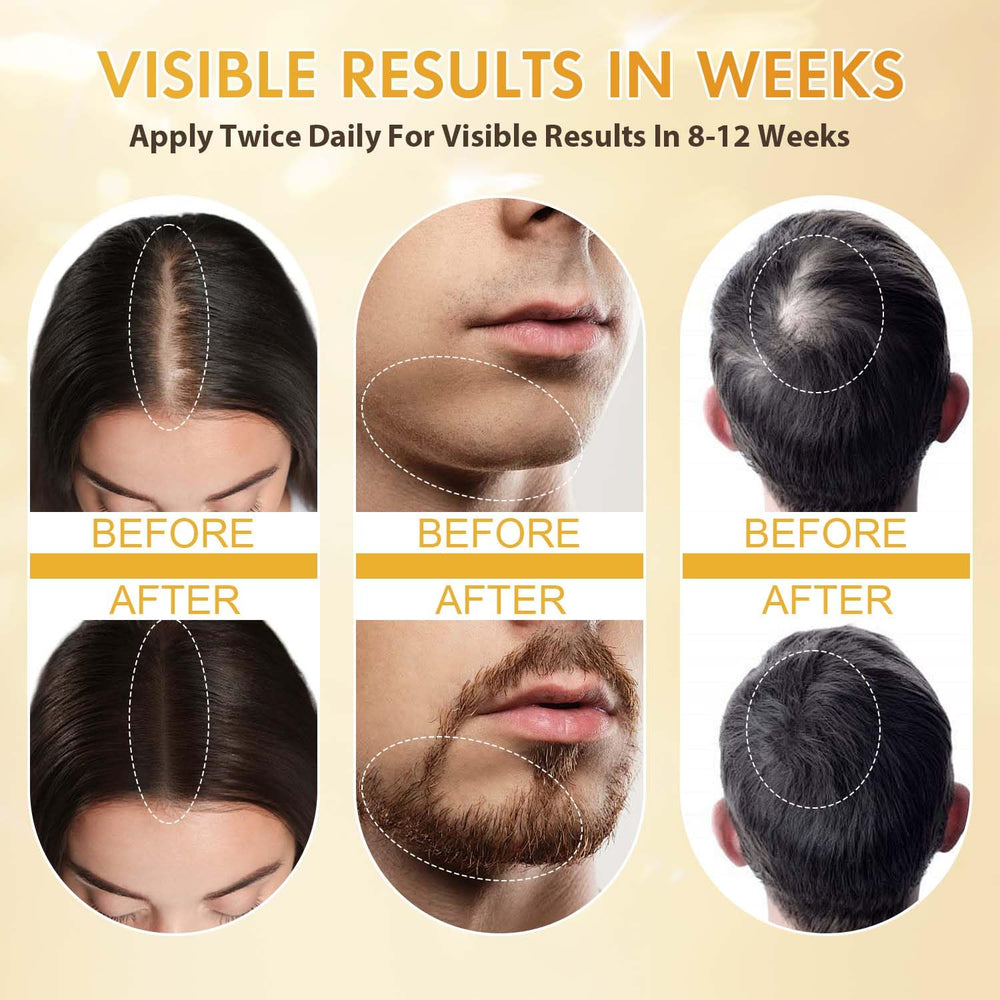 ZYXN Minoxidil - ingrédients romarin et batana mis en avant